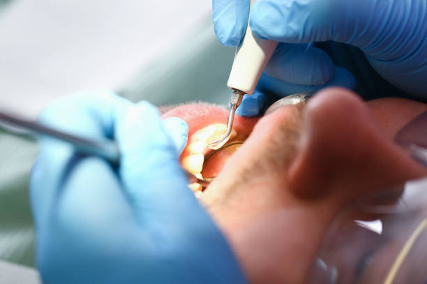 Best Emergency Tooth Extraction in Seven Lakes, NC